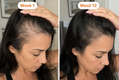 Gebruiker van het hoofdhuidserum, week 1 en week 12